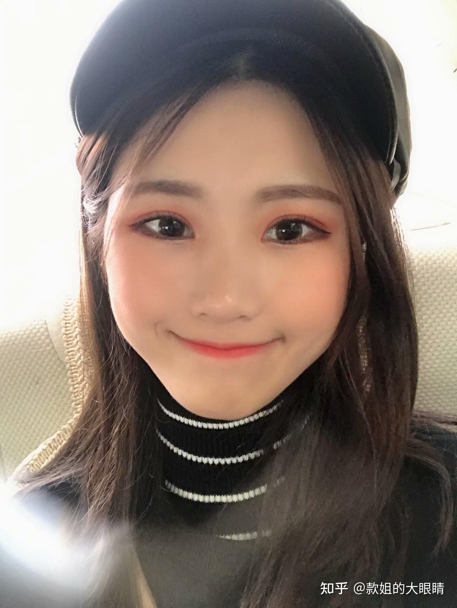 单眼皮小眼睛割了双眼皮术后是什么样子?