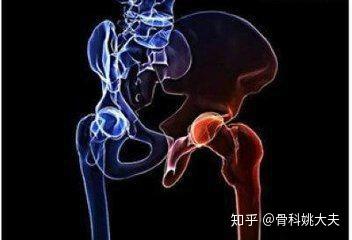 大腿根部疼多是得病了 大腿根部疼的四种原因 很多人不知道 知乎 大腿根部疼多是得病了 大腿根部疼的四种原因 很多人不知道 知乎