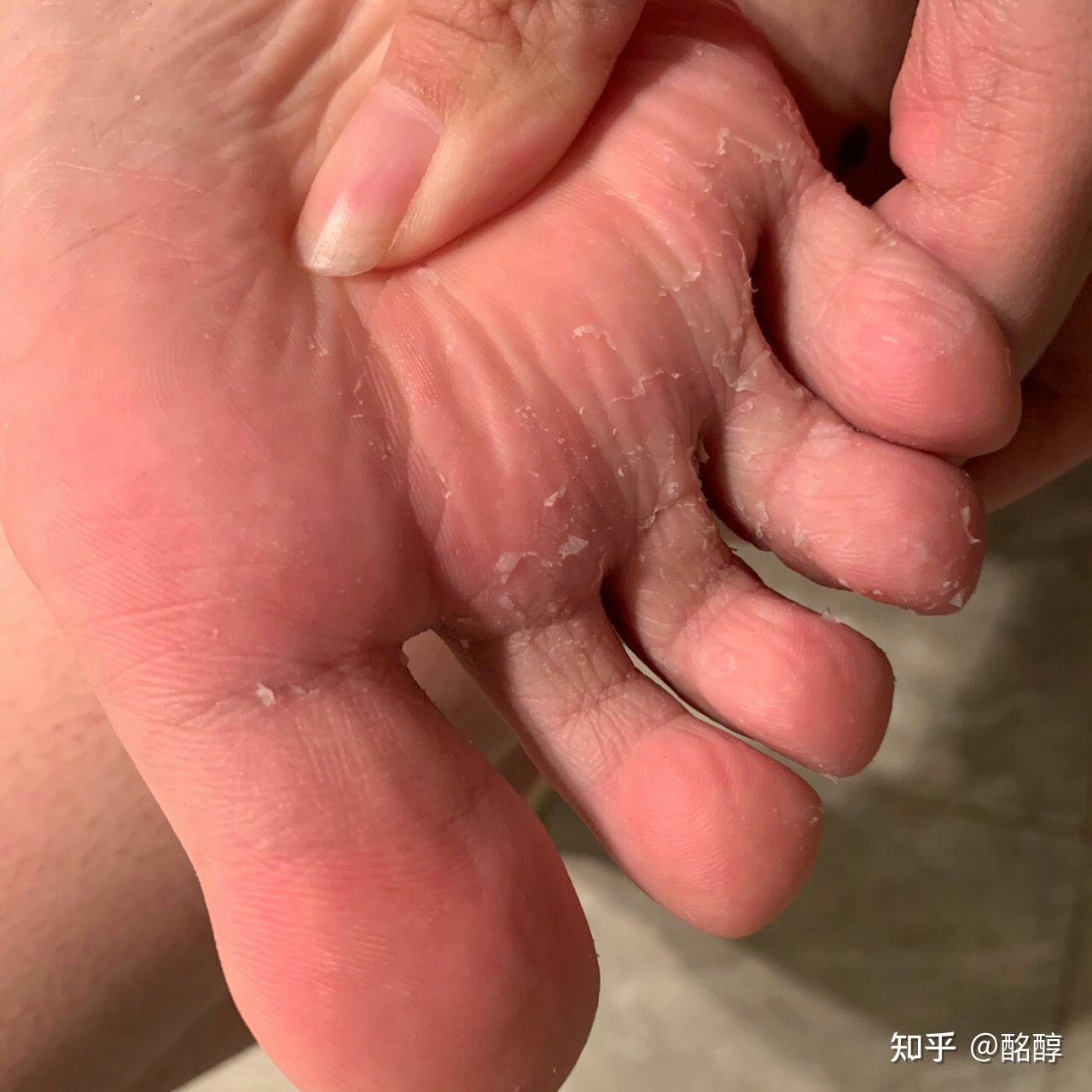 每天晚上回去就是脚气发作的时候,那种钻心地痒,太痛苦了,我还是一个