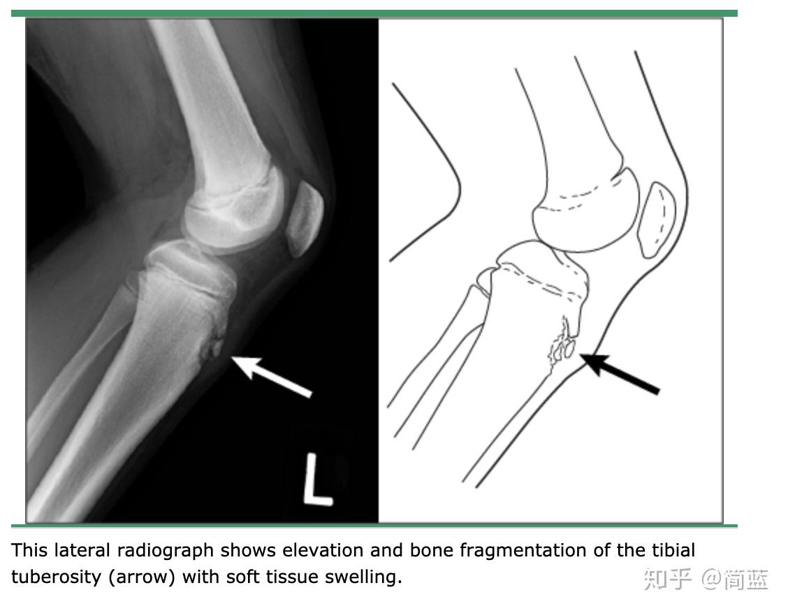 胫骨结节怎么治图片