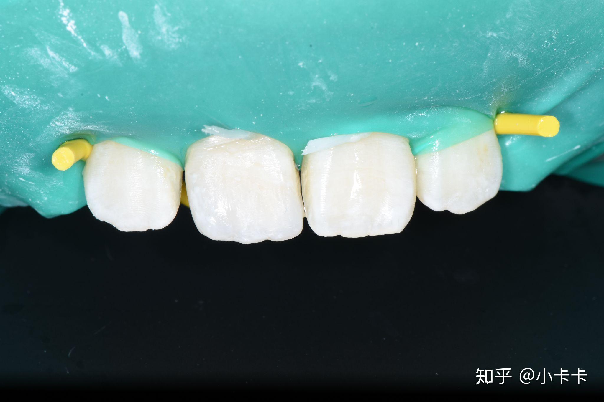 前牙外伤一周美塑树脂补牙一例