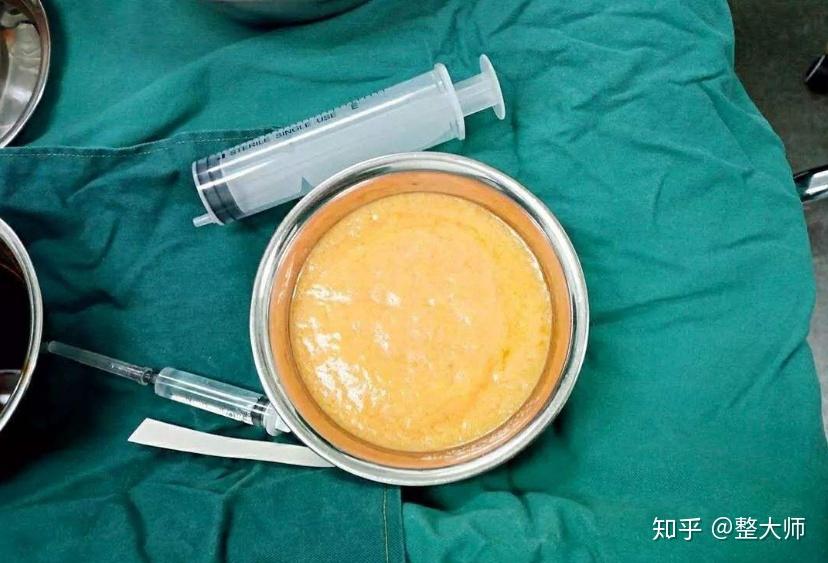 教你认清脂肪移植中的陷阱