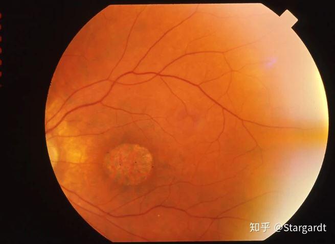 病理分析 | 锥杆细胞营养不良疾病综述