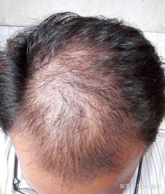 泄泻不止以至脱发益气健脾是根本实例分享2个月生发成功秘方