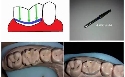 个人认为,后牙全冠,如果龈合高度合适,做龈上肩台或者齐龈肩台比较好.