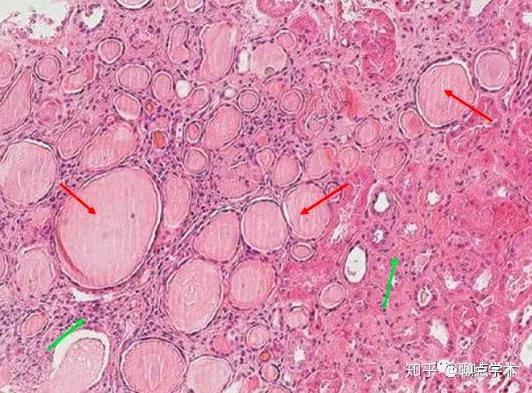 (肾脏he染色,图片来自网络)术后21天,间质炎细胞浸润存在,但不是主要