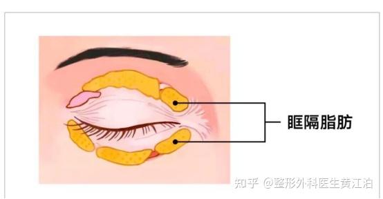 解救你的同款腫眼泡