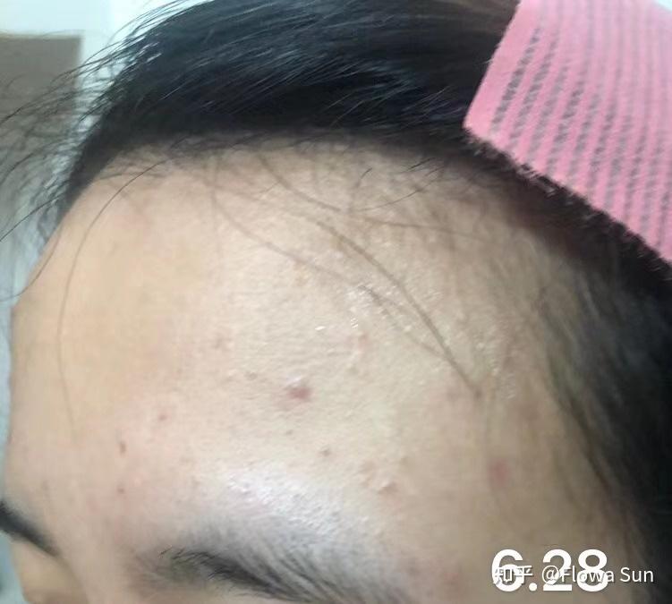 痤疮糠秕孢子菌毛囊炎治疗过程附图