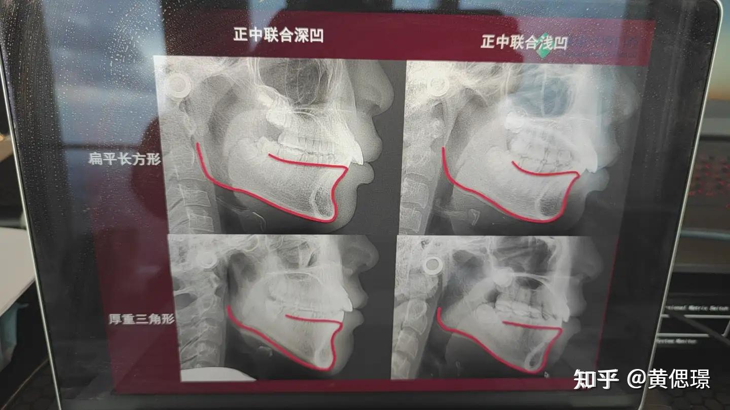 正畸诊断沈刚分类之凹面型 - 知乎