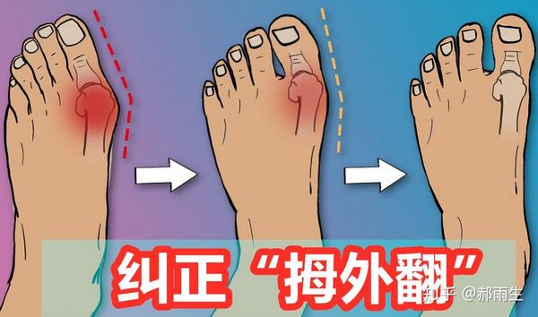 牛江红解说，什么是拇囊炎? - 知乎