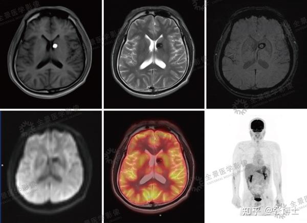 PET/MR神经系统中检查应用 - 知乎