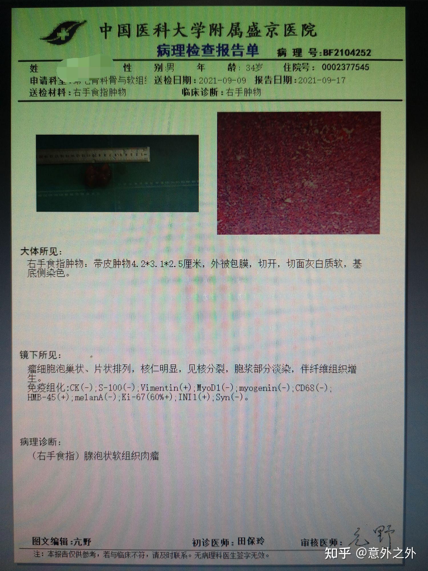 软组透明细胞肉瘤记录二