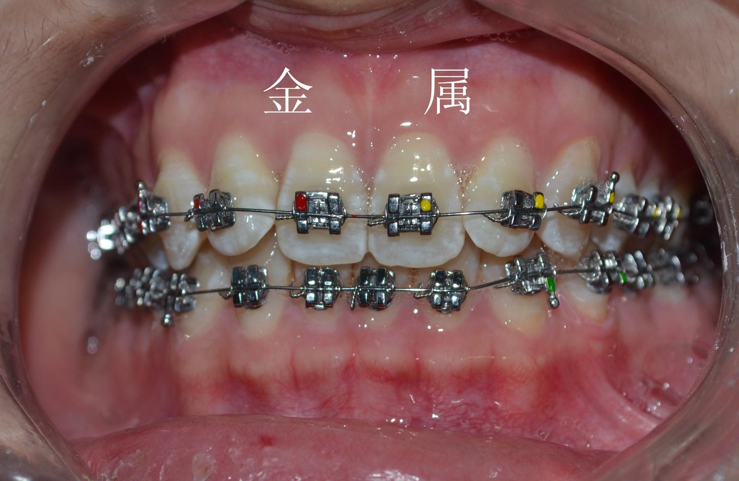 粘托槽痛吗?你知道托槽是如何粘上去的吗?