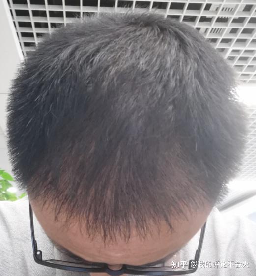 秃顶植发啥意思(秃顶植发啥意思啊)