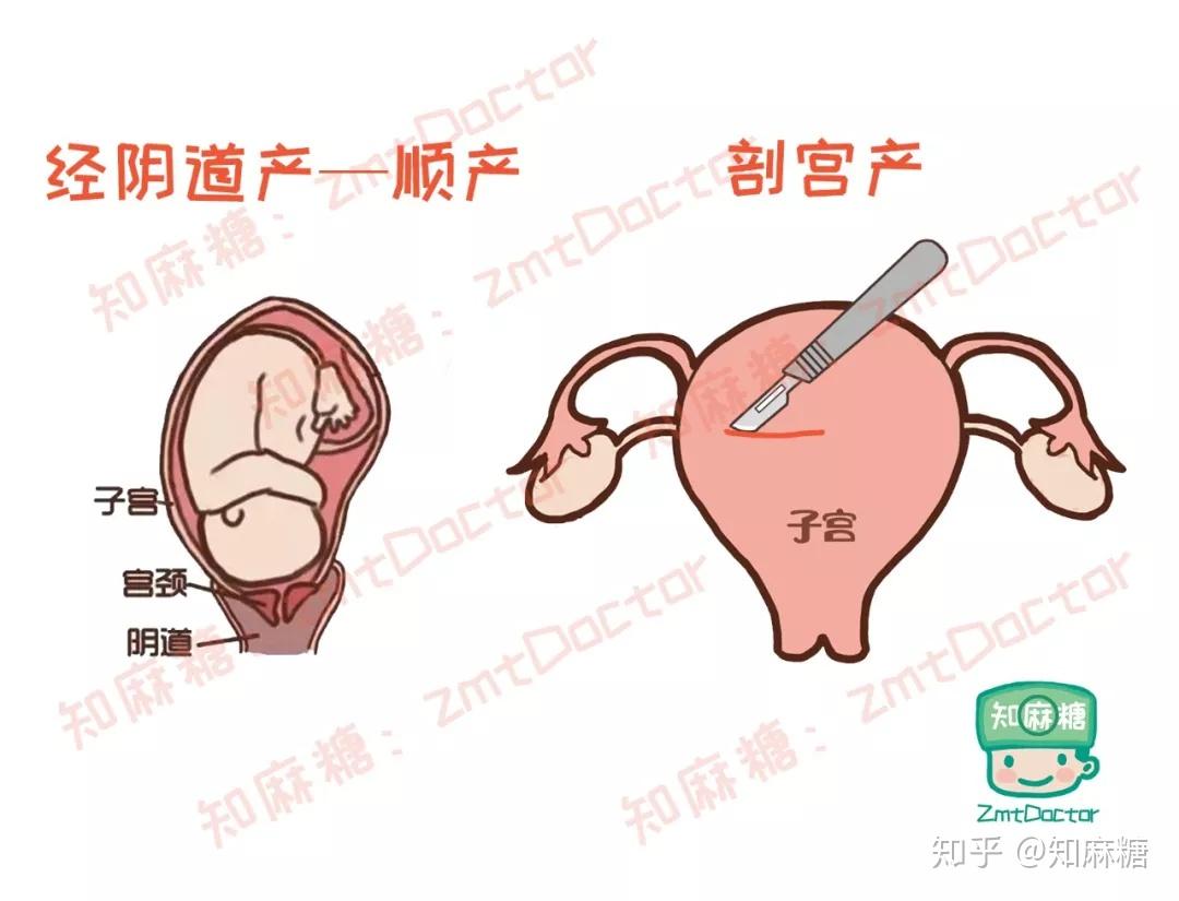 剖宫产又多了一宗罪,会造成新生儿肠道菌群发育不良?