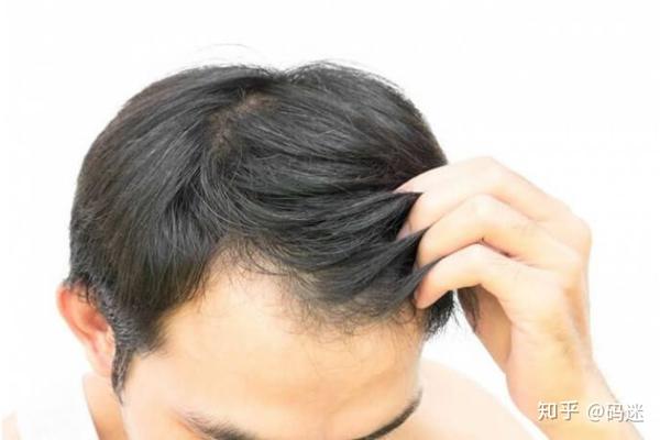 年去屑洗发水选购指南 该和头皮屑彻底说拜拜了 知乎