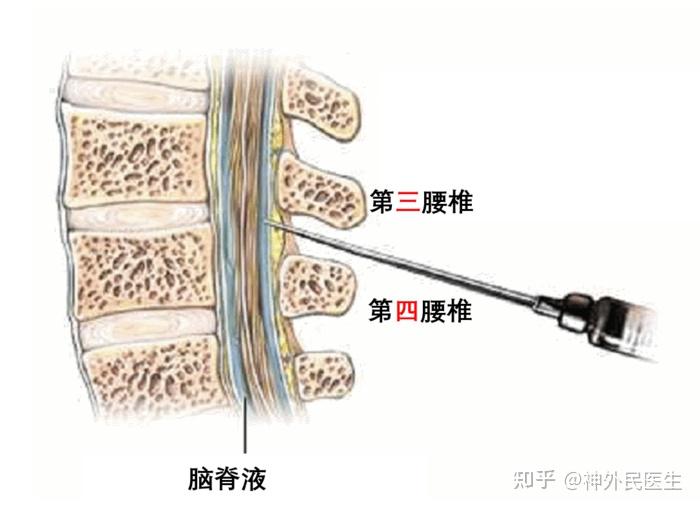 腰穿层次解剖图图片