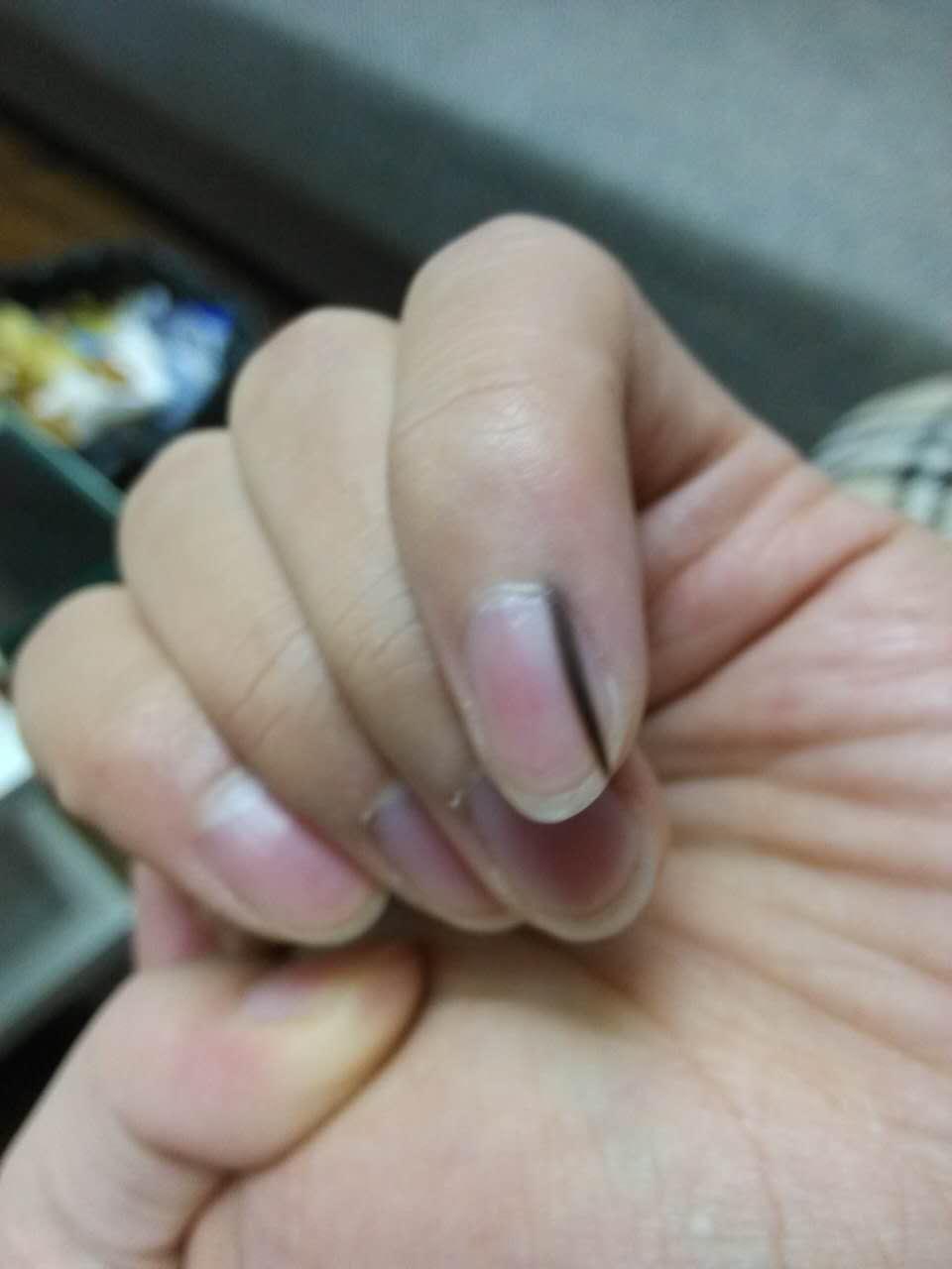 指甲上有一条淡淡黑线怎么回事两年了