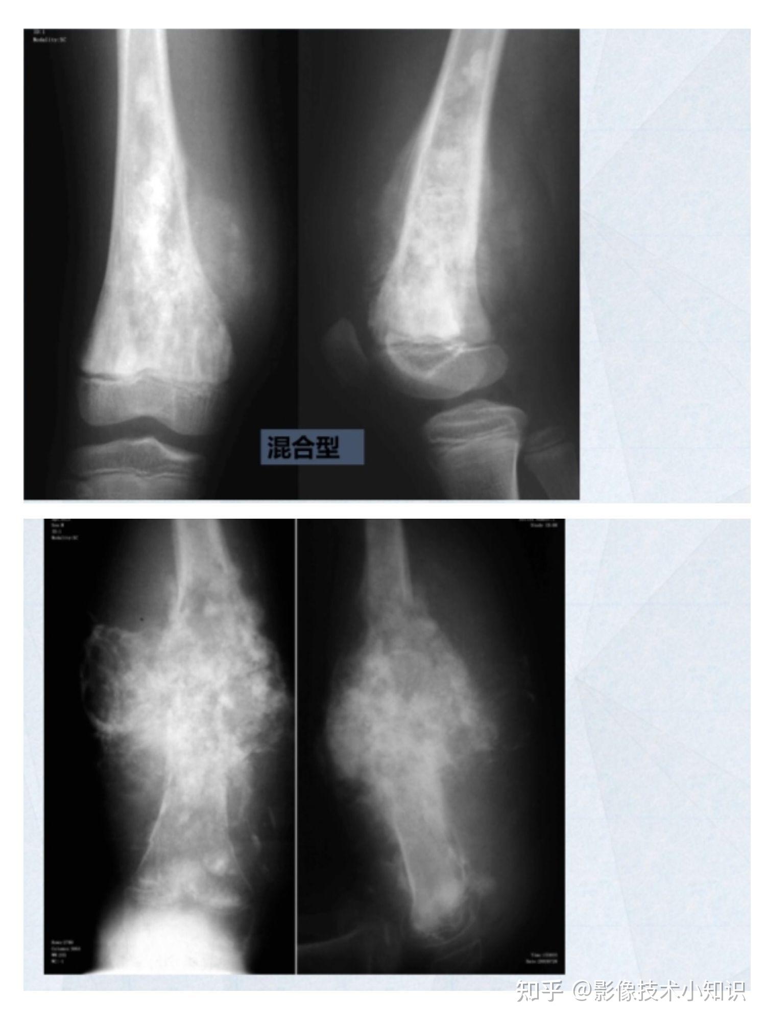 骨肉瘤片子图片