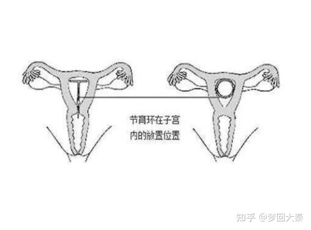 妇女节育 放置图片