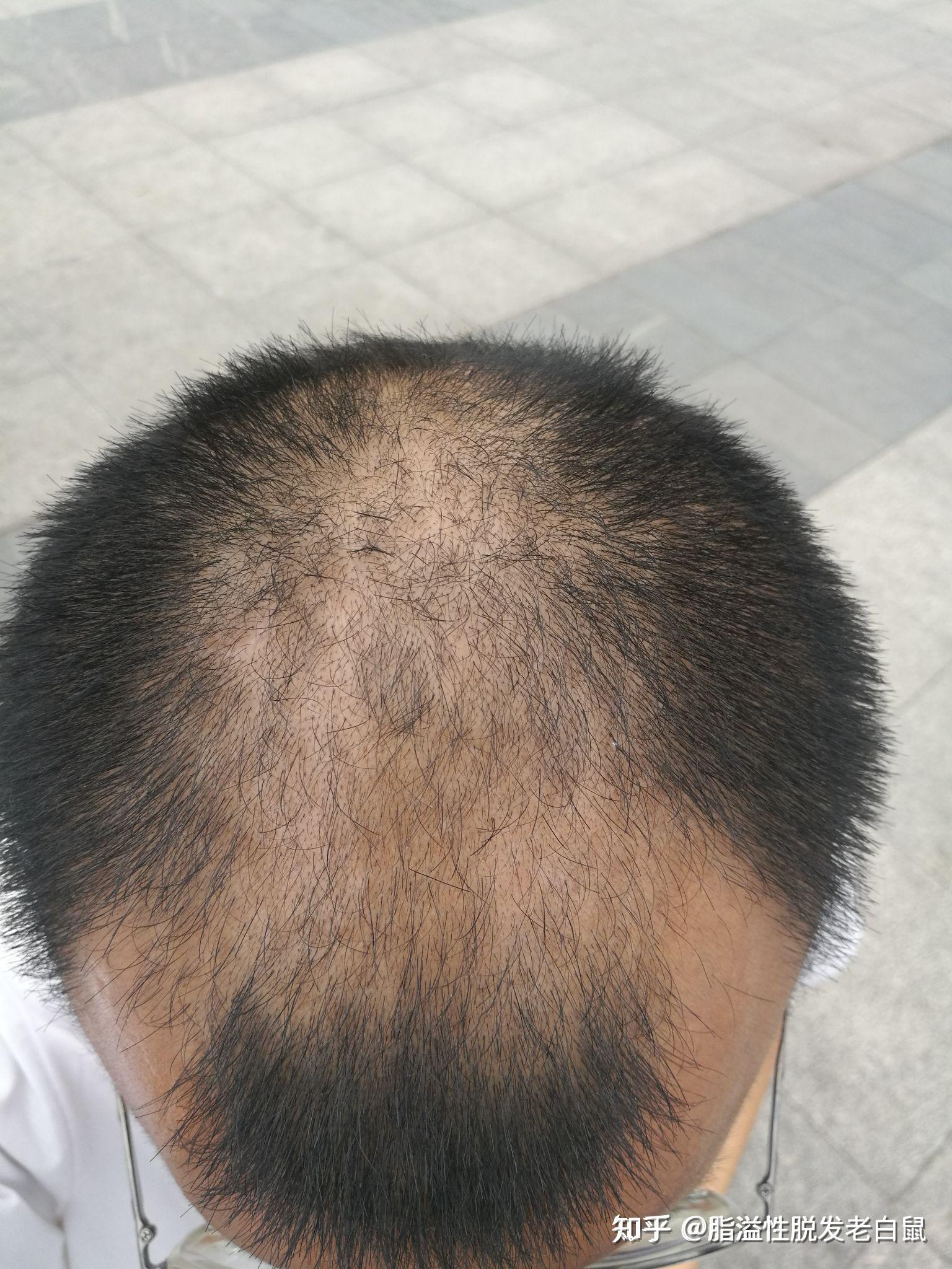 男性脂溢性脱发,恢复一年的效果展示 