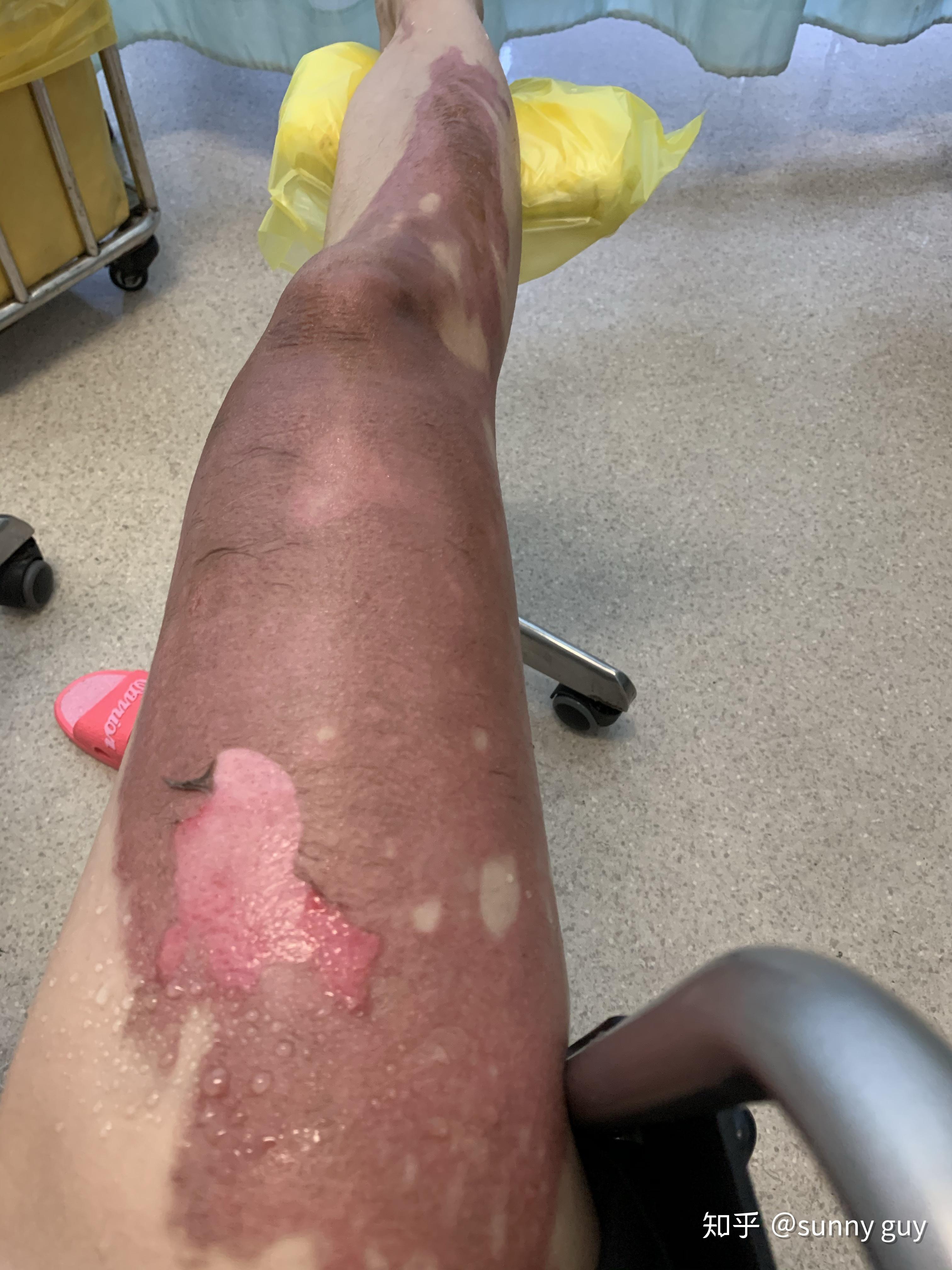 我的双腿2度烫伤治疗过程