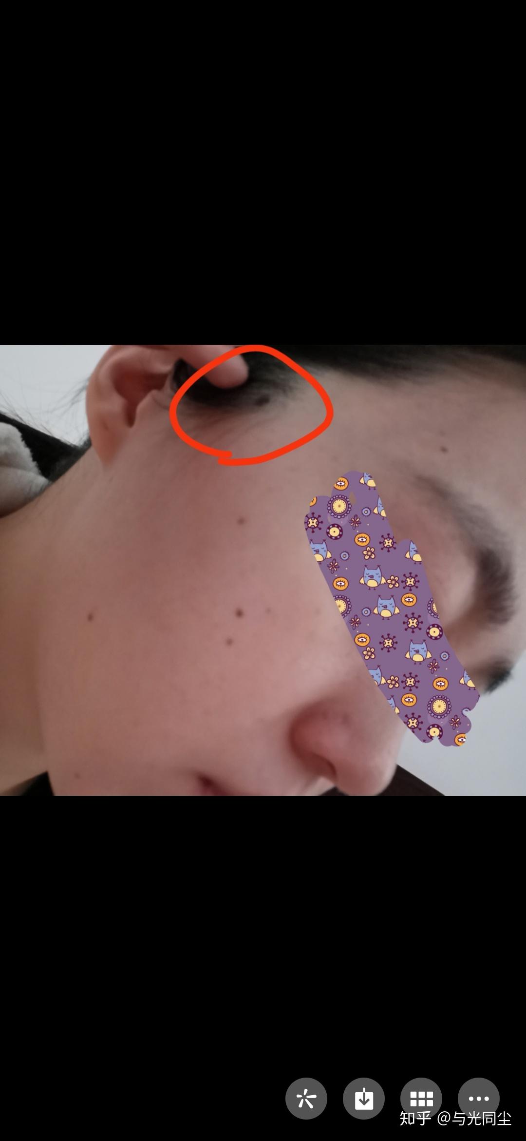 冬日除痣好时节点痣及术后全过程分享