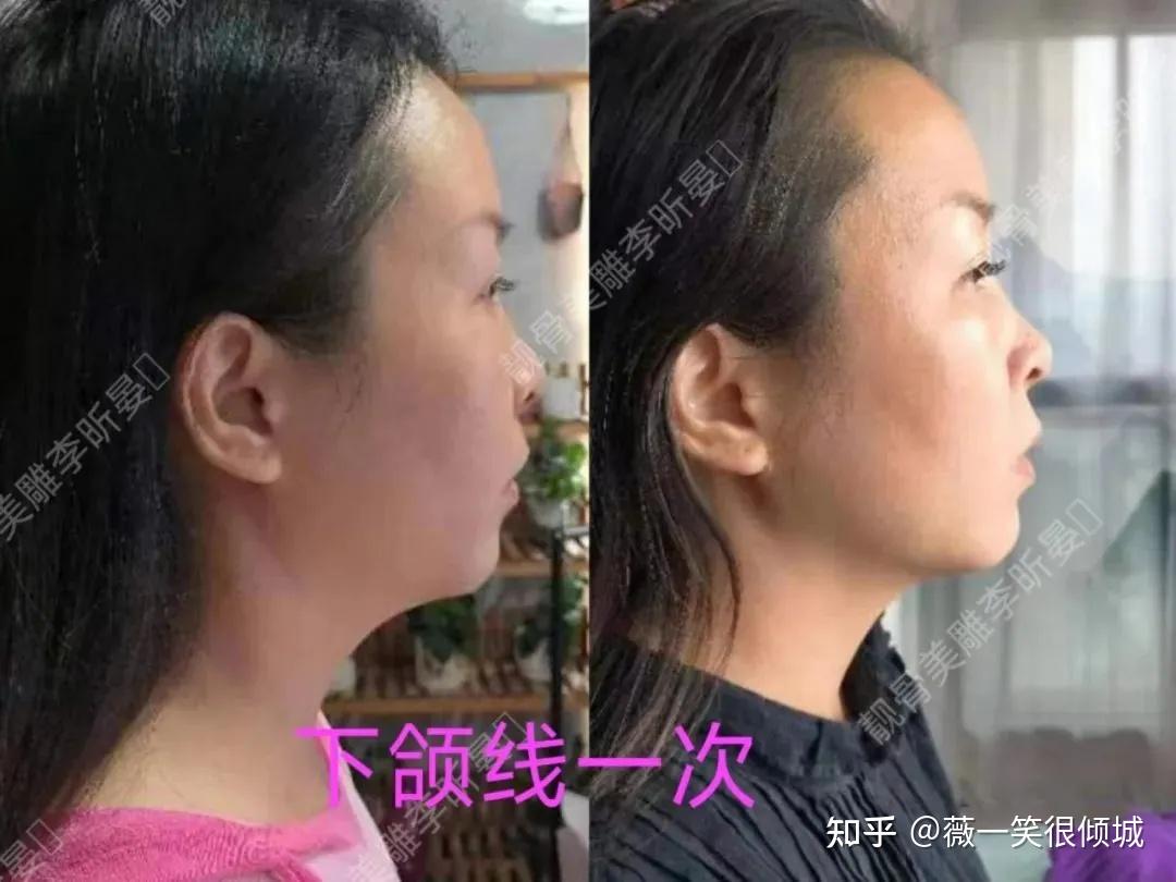 【李昕晏】【石家庄】靓骨美雕面授课（针灸美雕班） - 知乎