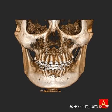 广州医科大学附属口腔医院陈建明正畸后想自杀