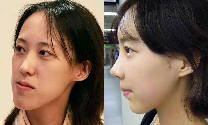 当你还跟你的眼睛鼻子死磕的时候,其实不妨看看你周围戴过牙套的朋友