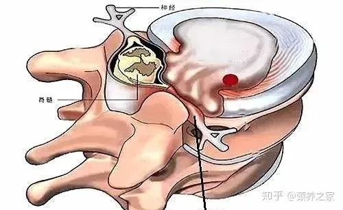 新冠肺炎无症状感染者可怕 无痛症颈椎病 就不可怕 知乎