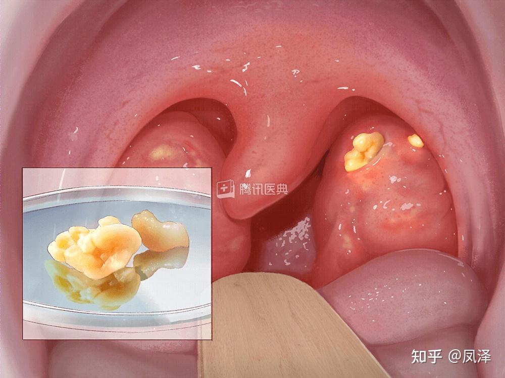 舌根结石图片