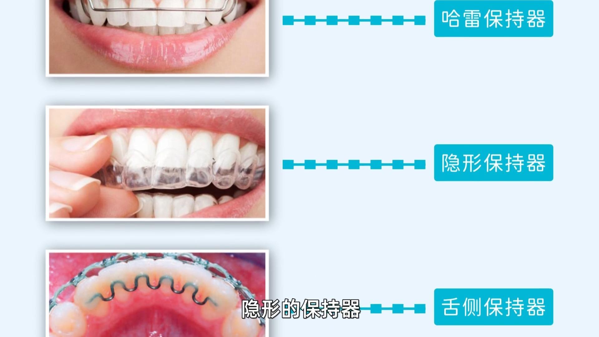 正畸保持器有哪些种类?