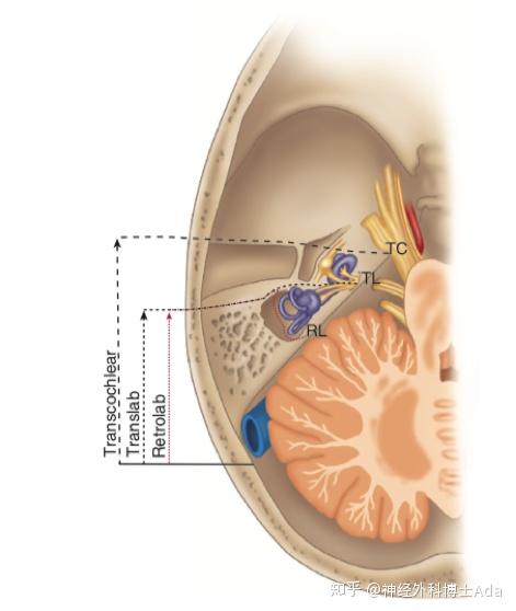 聽神經瘤常用的3種手術入路的解剖標誌,包括乙狀竇後入路,經迷路入路
