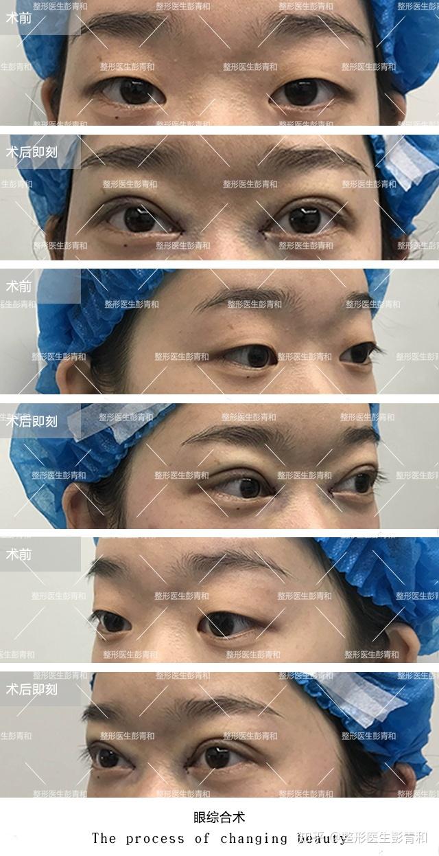 一文带你了解切开重睑术之技术要点