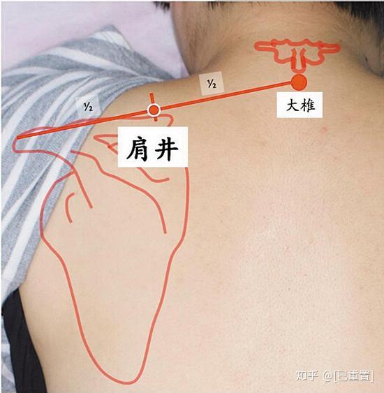 的肩井穴位置,以及两个肩胛骨的内侧,臀部的外上部位按压疼痛明显