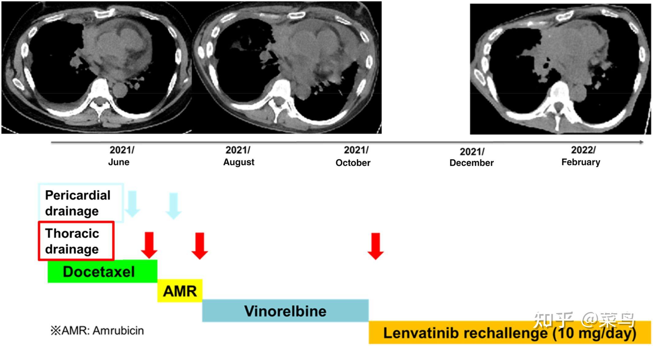 乐伐替尼在晚期胸腺癌患者中的再给药:病例报告 - 知乎