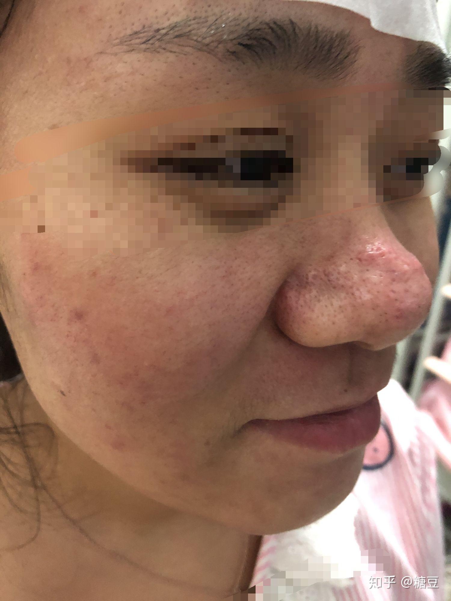 酒糟鼻点阵激光记录 - 知乎