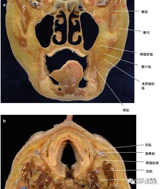 a頭部冠狀面顯示的頰脂肪墊b頭部水平面顯示的頰脂肪墊頰脂肪墊是面部