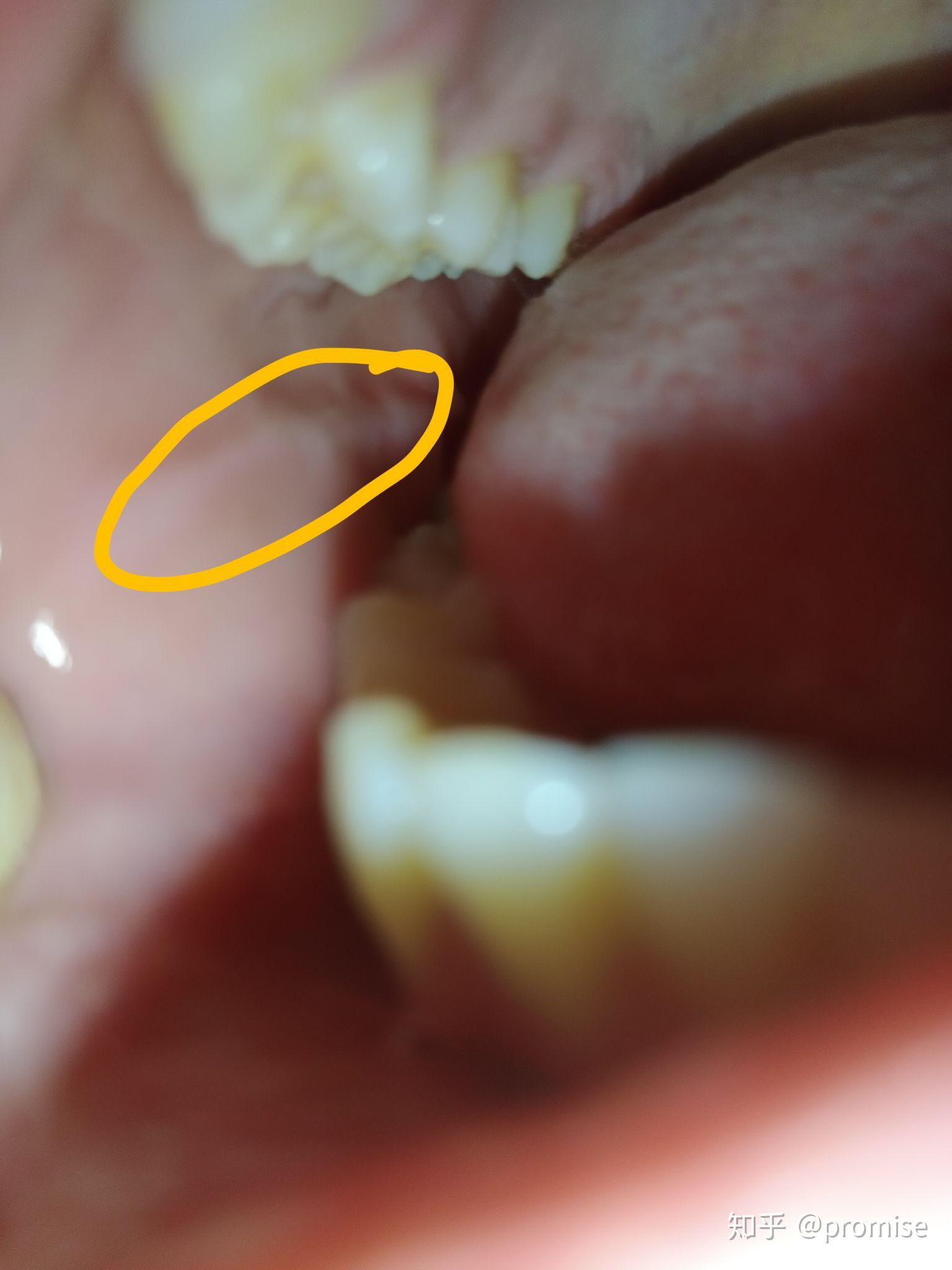 口腔溃疡疼死了咋办啊