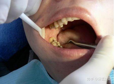 牙龈盲袋是什么图片