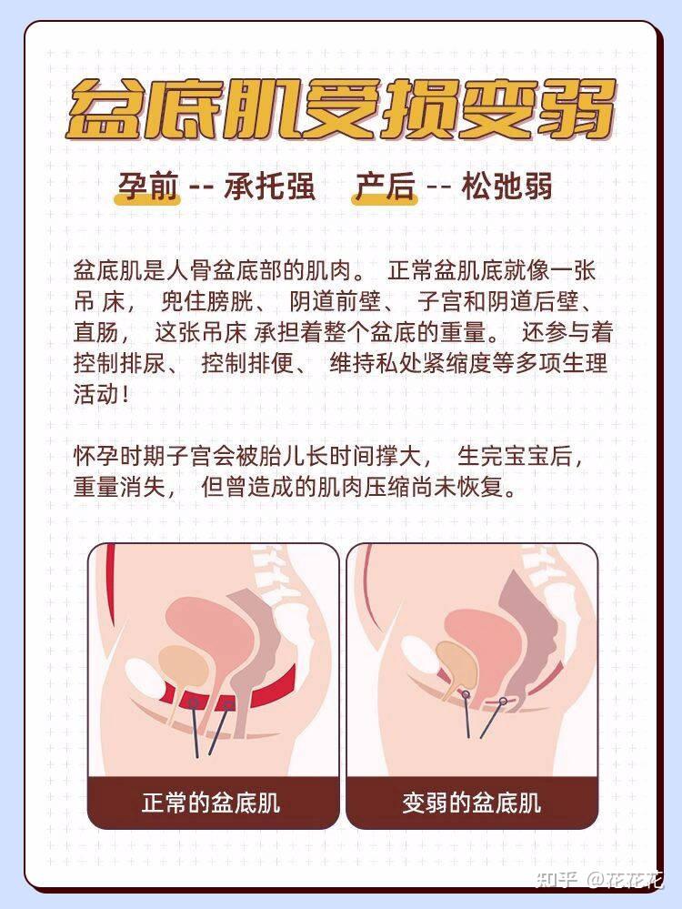 产后盆底肌修复