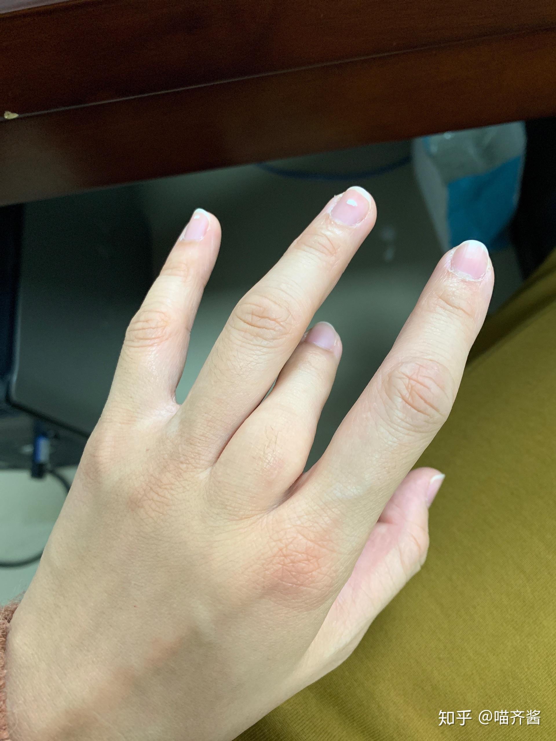 生来如此的手指不影响正常生活可有文献记载为何造成