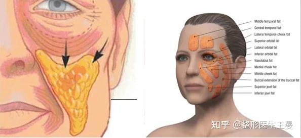 曼聊抗衰面部脂肪多的人可以做埋线提升么