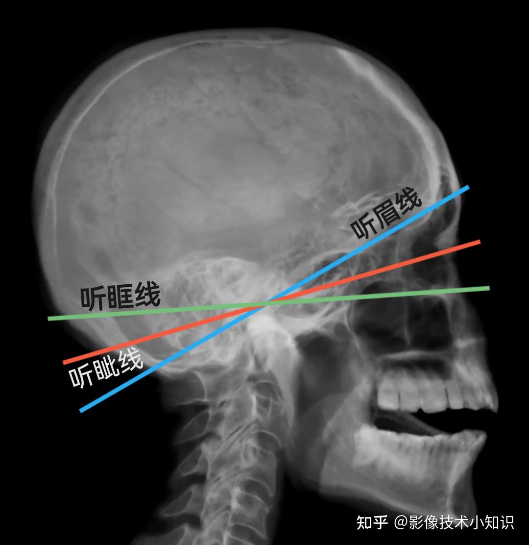 如果拍出头颅CT标准片(2) - 知乎
