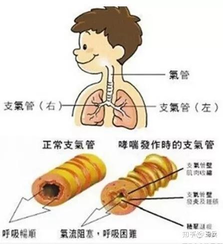 气道高反应性咳嗽特点图片