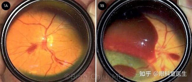 多为双眼的视网膜前或玻璃体出血,未查到其他视网膜的原发病变①单眼