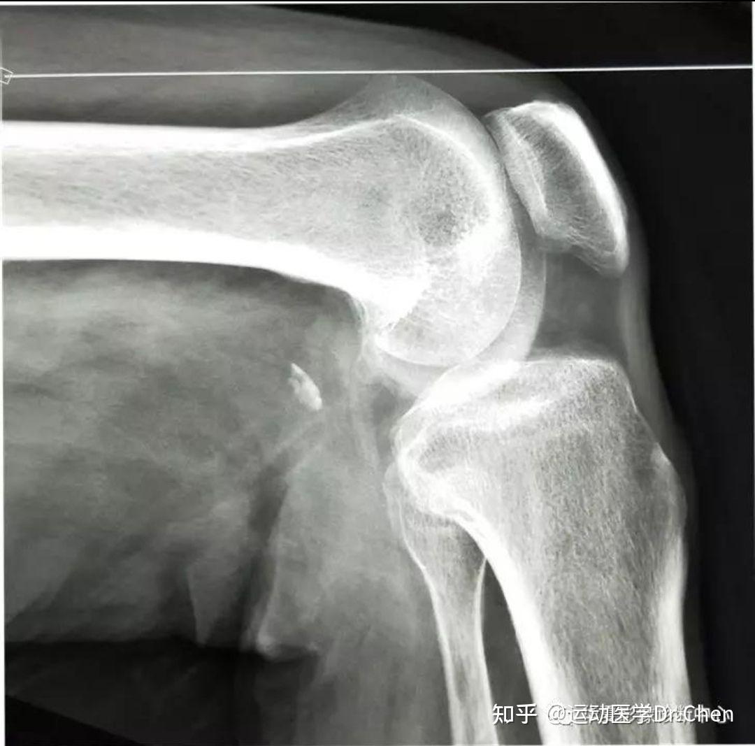 髌骨骨裂x光图片,你看膝关节光片图,髌骨正常位置光图(第10页)_大山谷图库