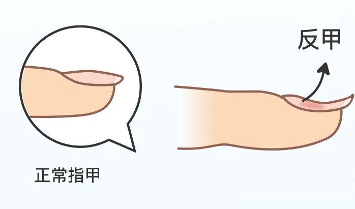 求助为什么我的指甲凹进去了