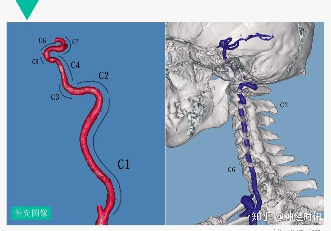 解剖cta头颈血管解剖与分段病例分享